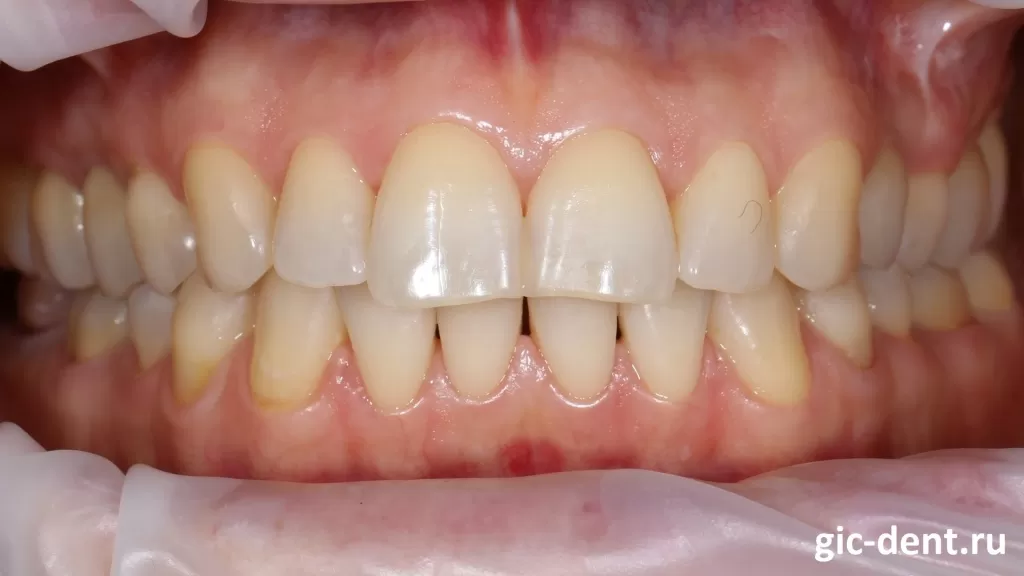 Протезирование группы жевательных зубов. Лечение проведено докторами НИЦ Аветисян Роберт и Дахкильгов Магомед